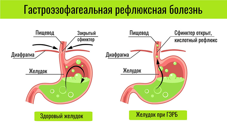 Гастроэзофагеальная рефлюксная болезнь